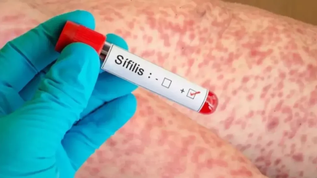 Alarmantes números de sífilis en el país