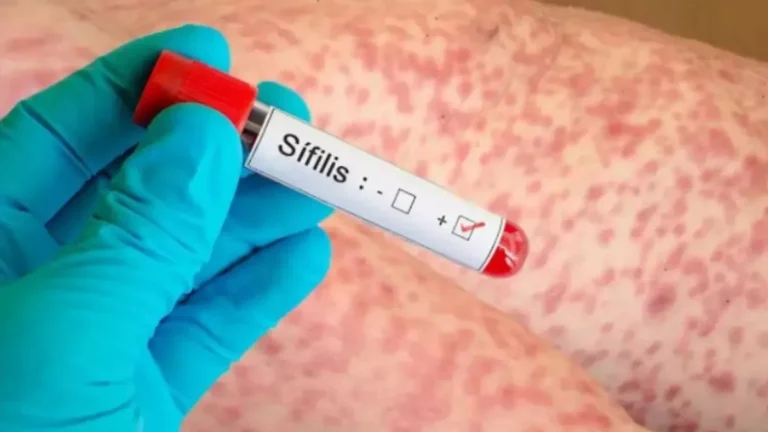 Alarmantes números de sífilis en el país
